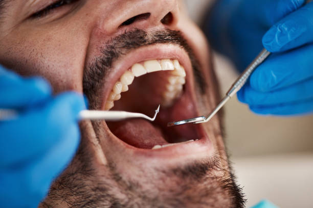 Best Wisdom Tooth Removal  in Fayette, MS